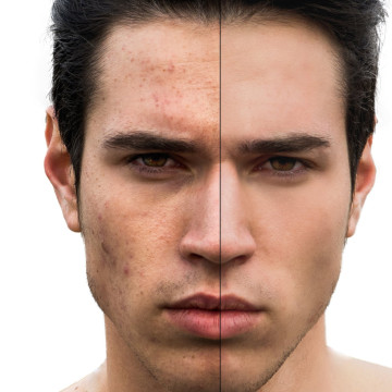 Aknebehandlung vorher nachher - bei Frau Dr. Habig -Junger Mann linke Gesichtshälfte mit Akne und rechts ohne Akne