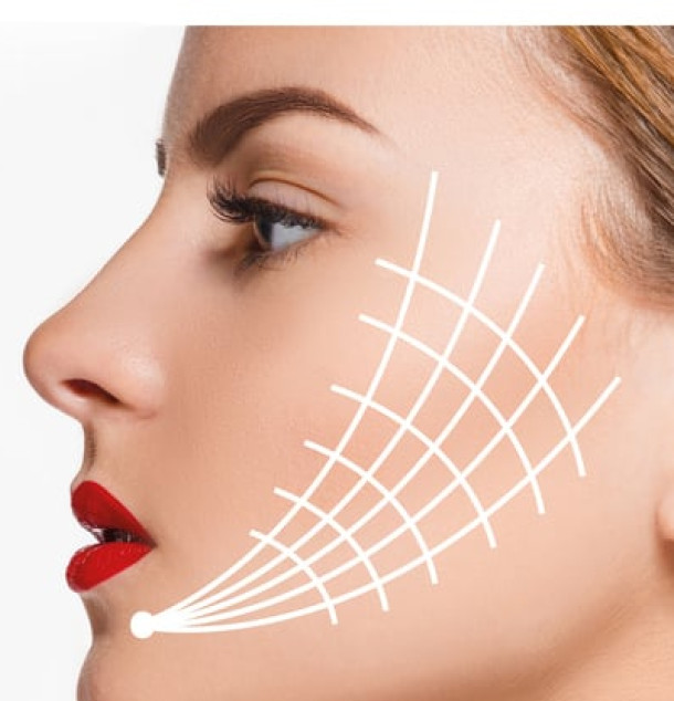 Fadenlifting München